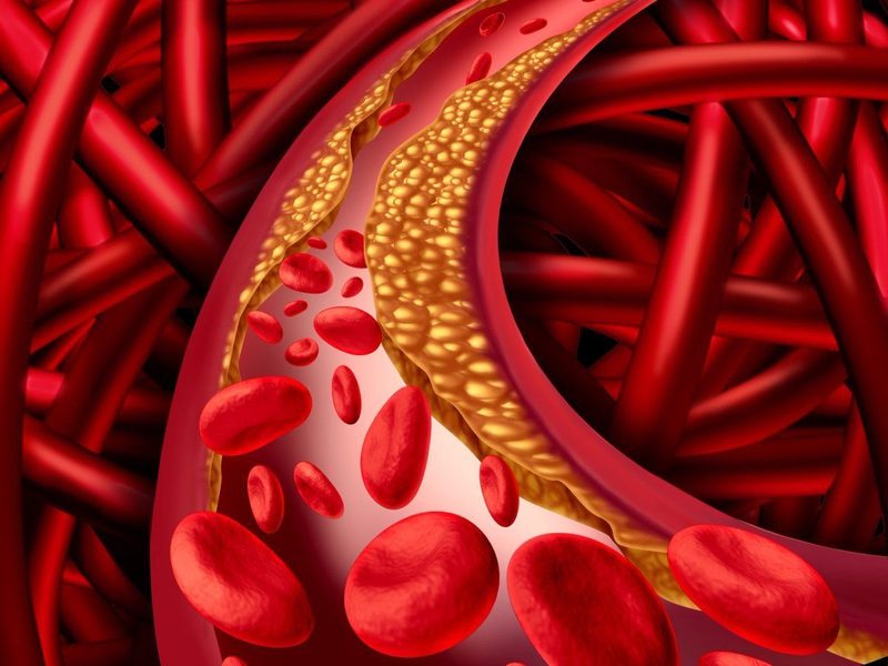 roi loan lipid mau 1 1