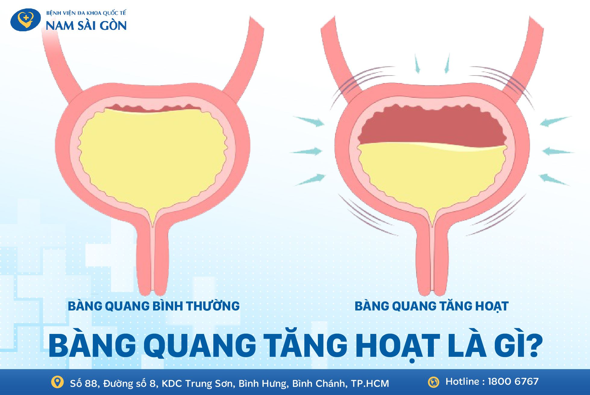BÀNG QUANG TĂNG HOẠT – NGUYÊN NHÂN, TRIỆU CHỨNG, CHẨN ĐOÁN VÀ ĐIỀU TRỊ