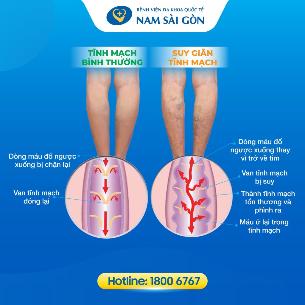 suy gian tinh mach chan 02 1