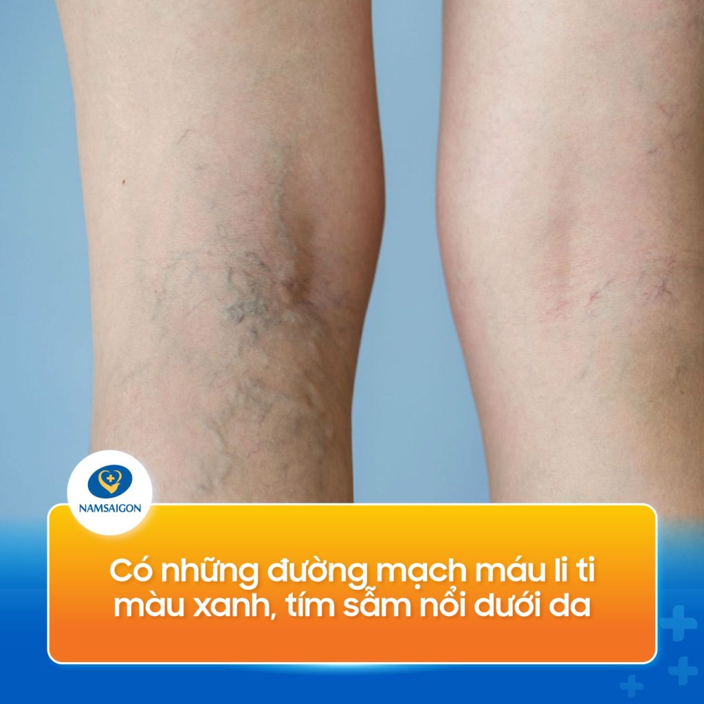 suy gian tinh mach chan 08