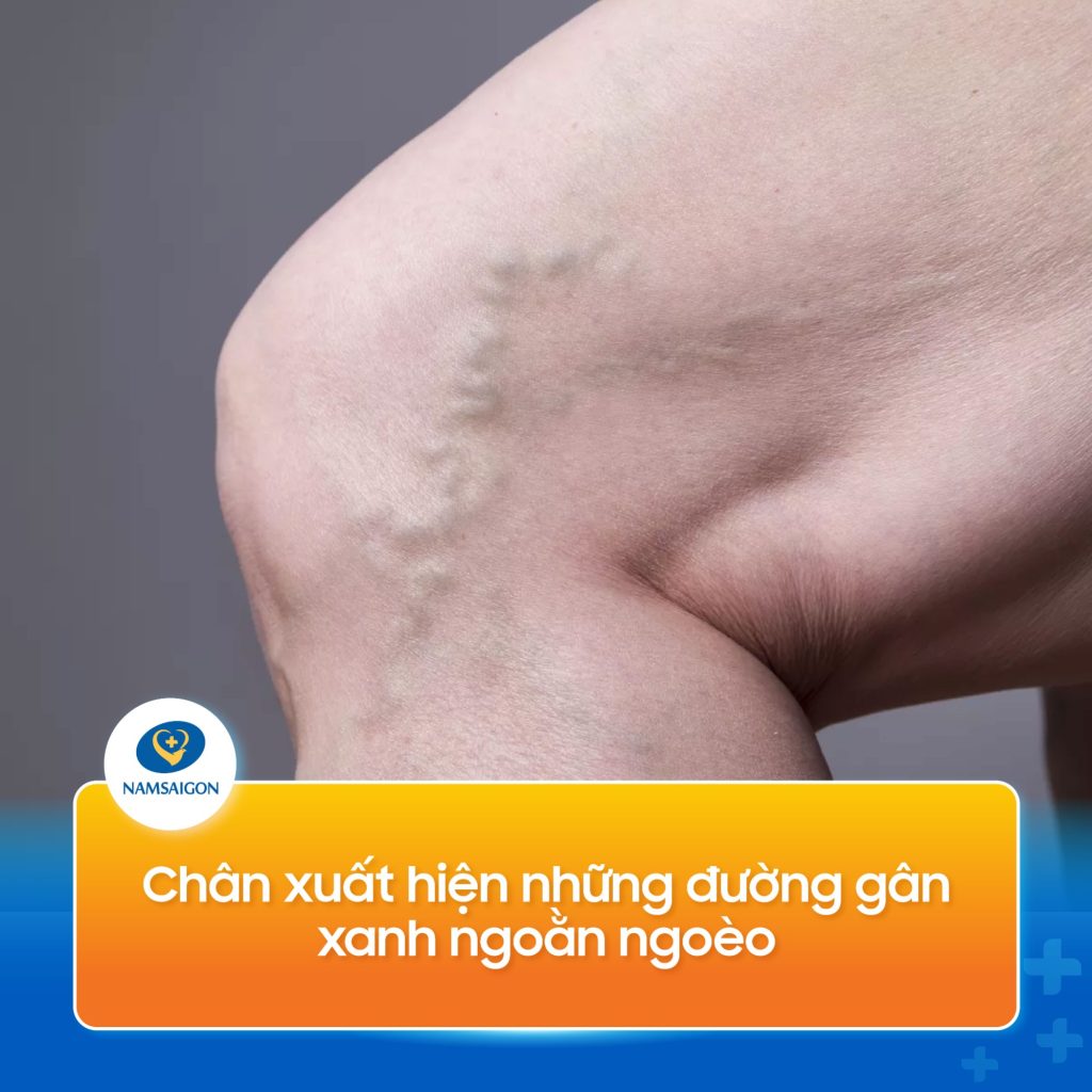 suy gian tinh mach chan 09