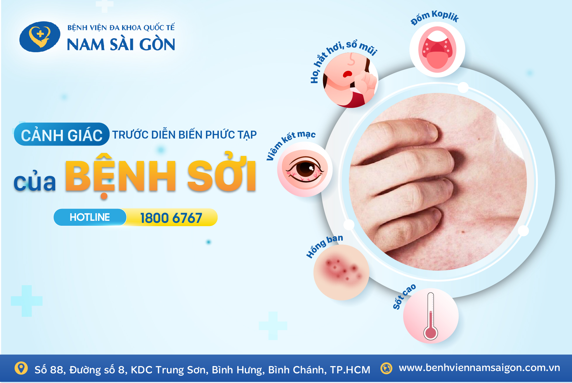 CẢNH GIÁC TRƯỚC DIỄN BIẾN PHỨC TẠP CỦA BỆNH SỞI