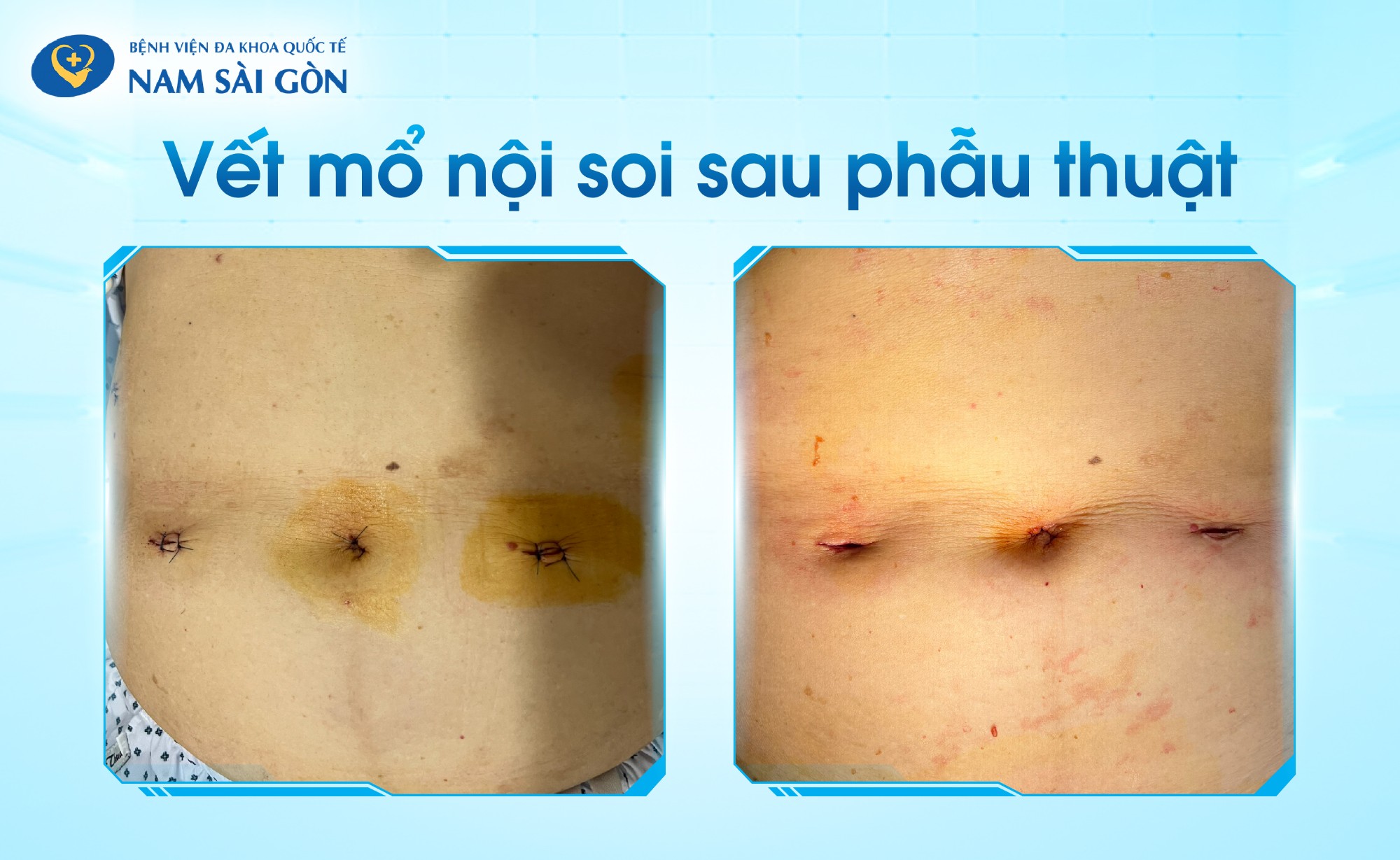 ung thu da day ap dung eras 05 web 1