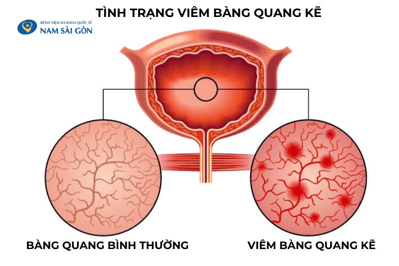 viem bang quang nam gioi 3 1
