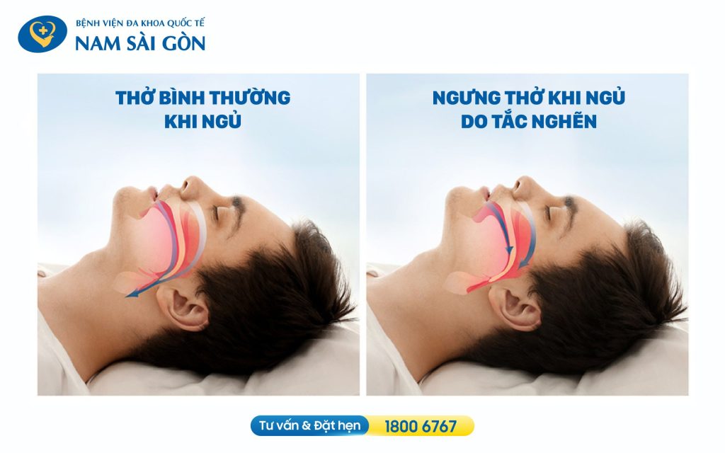 14 CÁCH TRỊ NGỦ NGÁY VÀ NGƯNG THỞ KHI NGỦ HIỆU QUẢ 3 Duong tho binh thuong Duong tho bi tac nghen