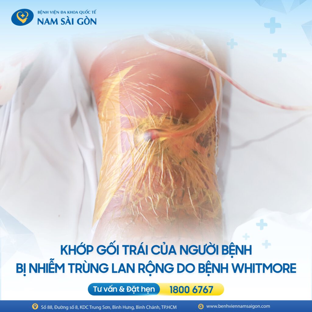 BẤT NGỜ PHÁT HIỆN NHIỄM “VI KHUẨN ĂN THỊT NGƯỜI” TỪ Ổ VIÊM KHỚP GỐI 4 THIET KE CA BENH HOUT VANNY 02
