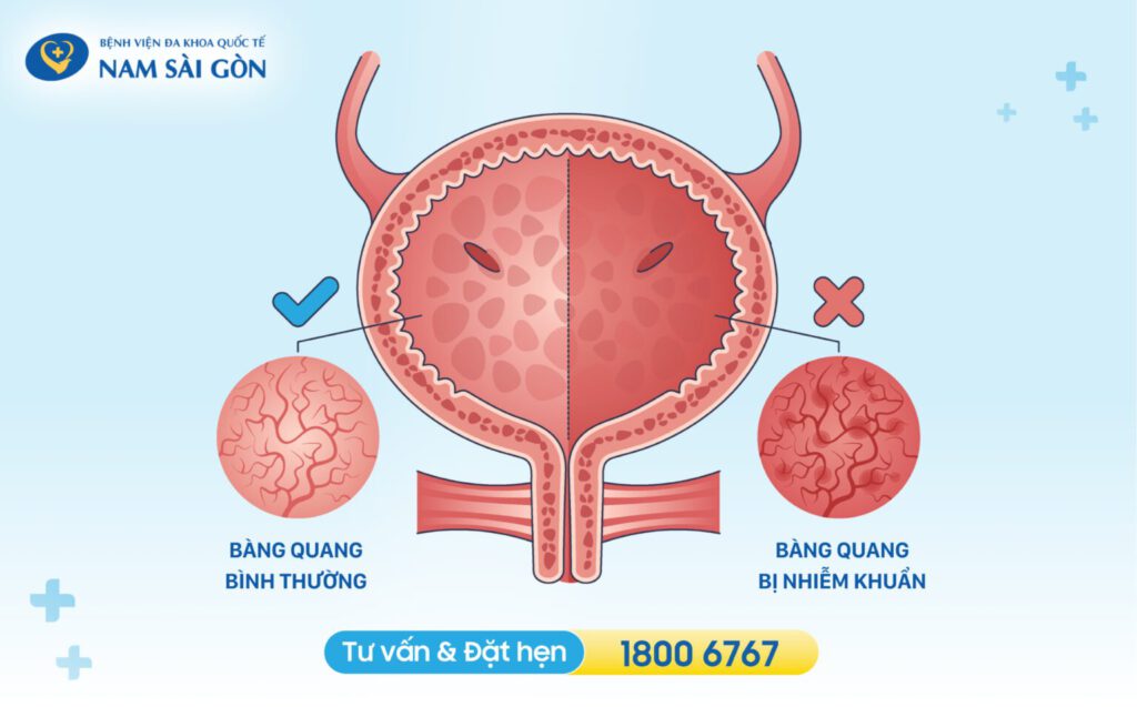 triệu chứng viêm bàng quang ở nữ