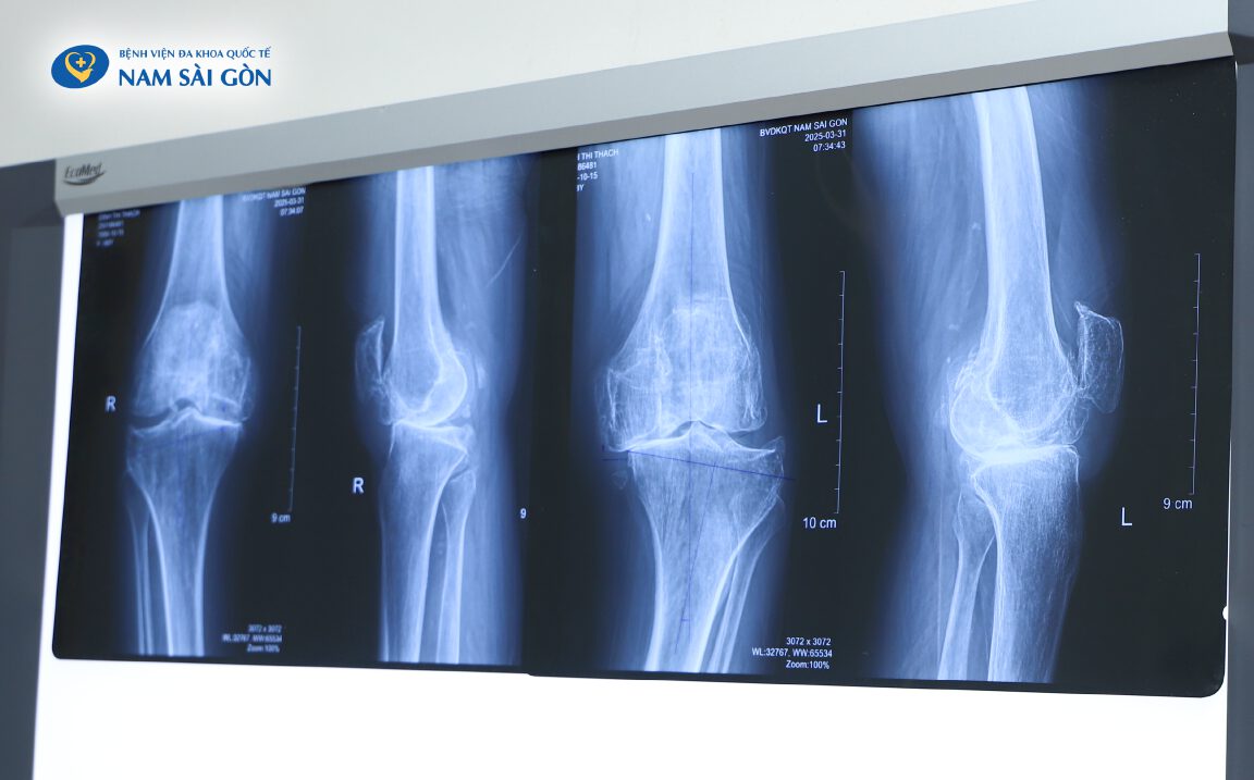 KHỚP GỐI BIẾN DẠNG DO DÙNG CORTICOID 1 Web H2 ca benh lam dung thuoc khop