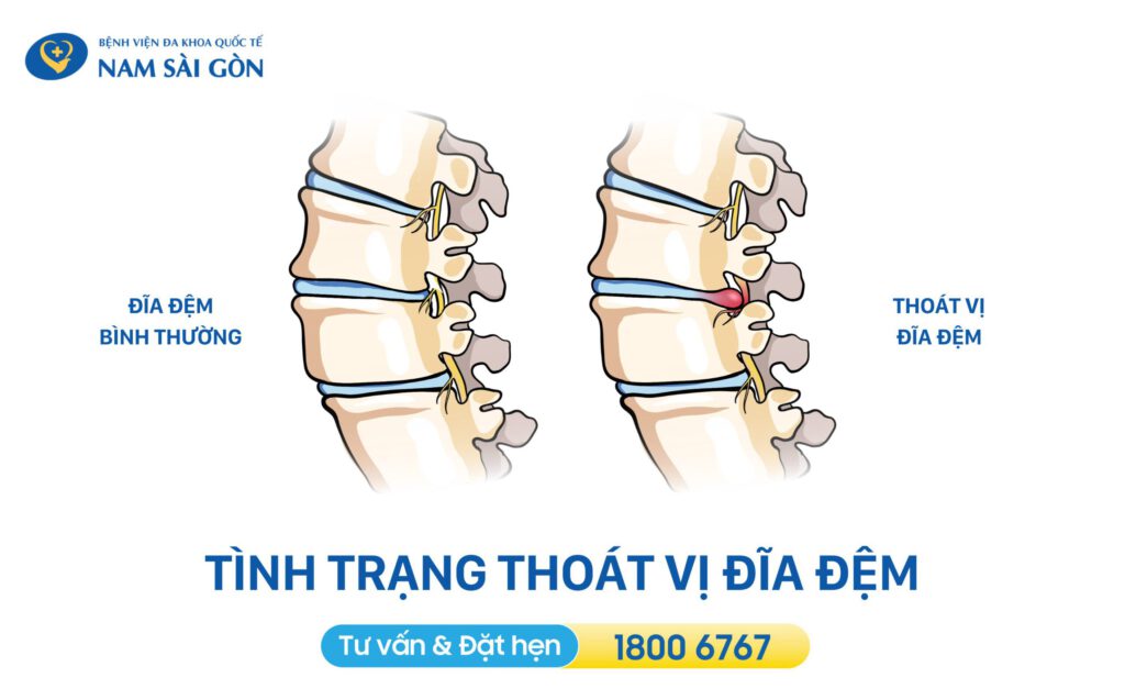 thoát vị đĩa đệm đau ở đâu
