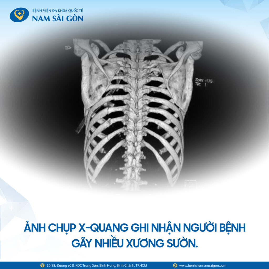 NGÃ TỪ ĐỘ CAO 4 MÉT - NGƯỜI PHỤ NỮ SUY HÔ HẤP, ĐỐI DIỆN NGUY CƠ TỬ VONG 4 THIET KE CA BENH BS VU HUU VINH 02