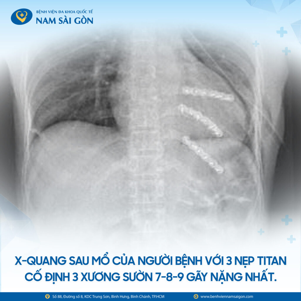 NGÃ TỪ ĐỘ CAO 4 MÉT - NGƯỜI PHỤ NỮ SUY HÔ HẤP, ĐỐI DIỆN NGUY CƠ TỬ VONG 6 THIET KE CA BENH BS VU HUU VINH 04