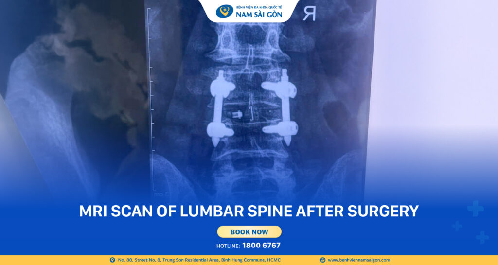 ENDOSCOPIC TREATMENT OF HERNIATED DISC: 74-YEAR-OLD MAN WALKS AGAIN AFTER 48 HOURS 5 Banner 2