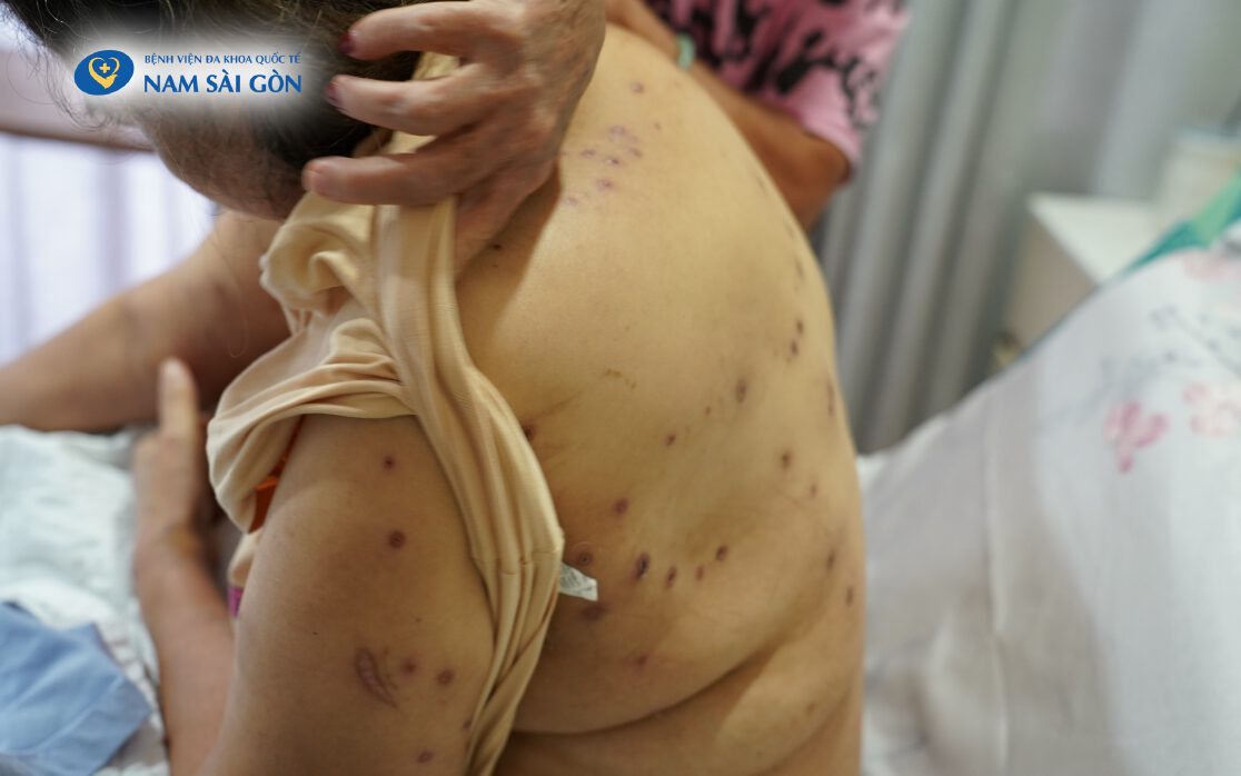 SAVED FROM LIFE-THREATENING ANAPHYLACTIC SHOCK AFTER 70 WASP STINGS 5 H1 Web 1