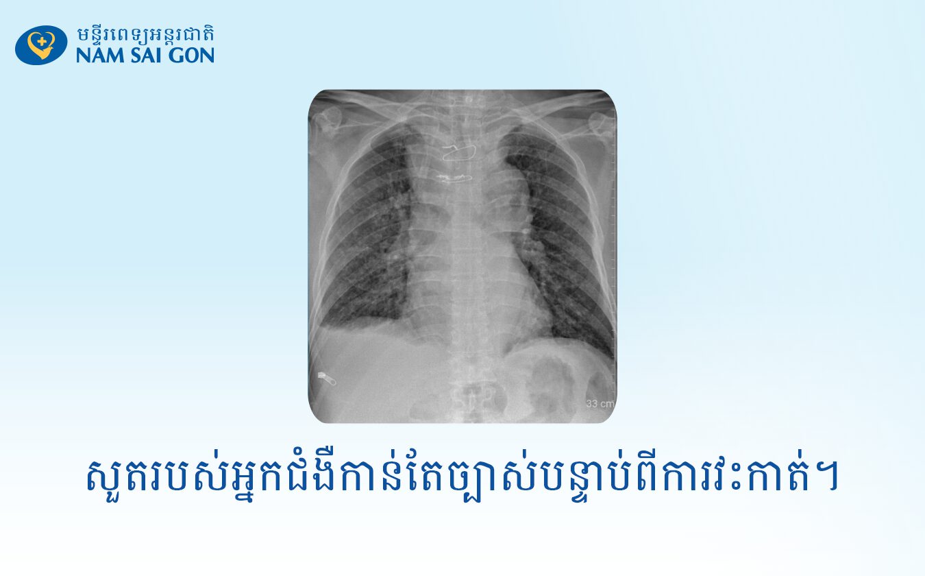 ករណីដ៏កម្រ៖ វះកាត់ដុំសាច់យក្ស "ទាំងមូល" នៅបំពង់ខ្យល់ - សង្គ្រោះផ្លូវដង្ហើមជួនអ៊ំប្រុសជនជាតិខ្មែរអាយុ 75 ឆ្នាំ។ 9 CA CHE XUONG UC CAT U 2 1