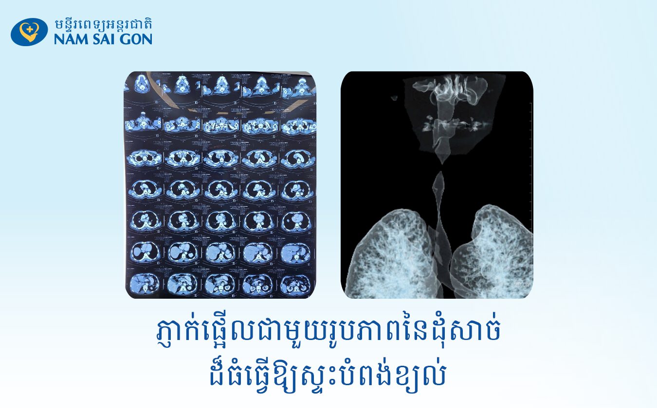 ករណីដ៏កម្រ៖ វះកាត់ដុំសាច់យក្ស "ទាំងមូល" នៅបំពង់ខ្យល់ - សង្គ្រោះផ្លូវដង្ហើមជួនអ៊ំប្រុសជនជាតិខ្មែរអាយុ 75 ឆ្នាំ។ 6 CA CHE XUONG UC CAT U