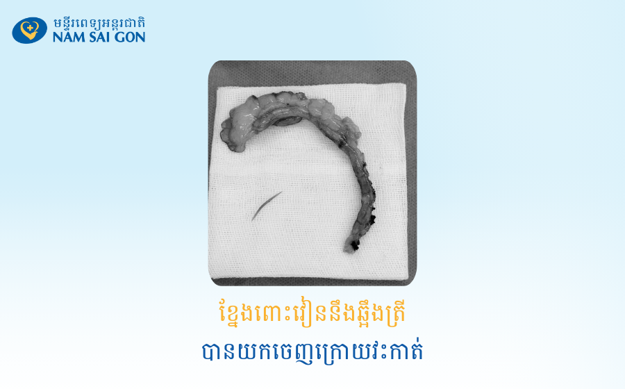 ឆ្អឹងត្រីបានលាក់ខ្លូនយ៉ាងសម្ងាត់ ស្ទើរតែសម្លាប់បុរសវ័យ64ឆ្នាំម្នាក់ 4 CA PHAU THUAT O BUNG XUONG CA Khmer
