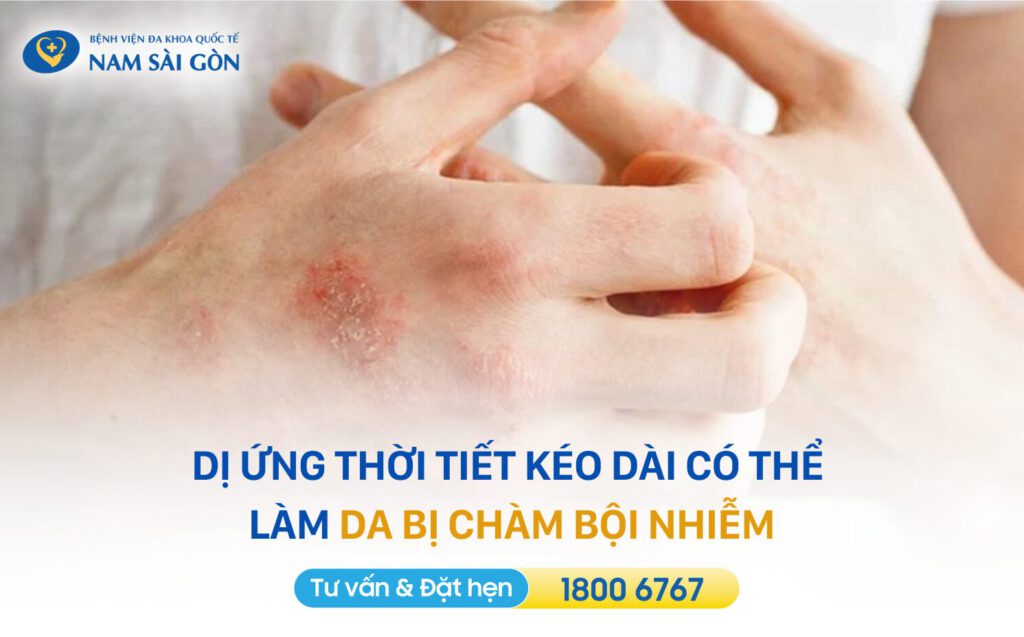bệnh dị ứng thời tiết bị dị ứng thời tiết