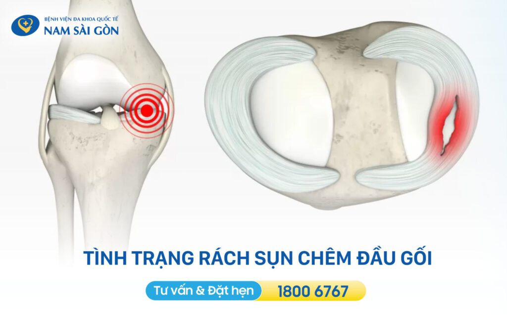 tình trạng rách sụn chêm đầu gối