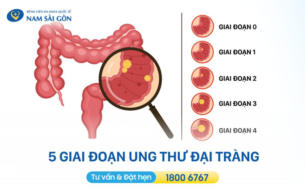 Các giai đoạn ung thư đại tràng