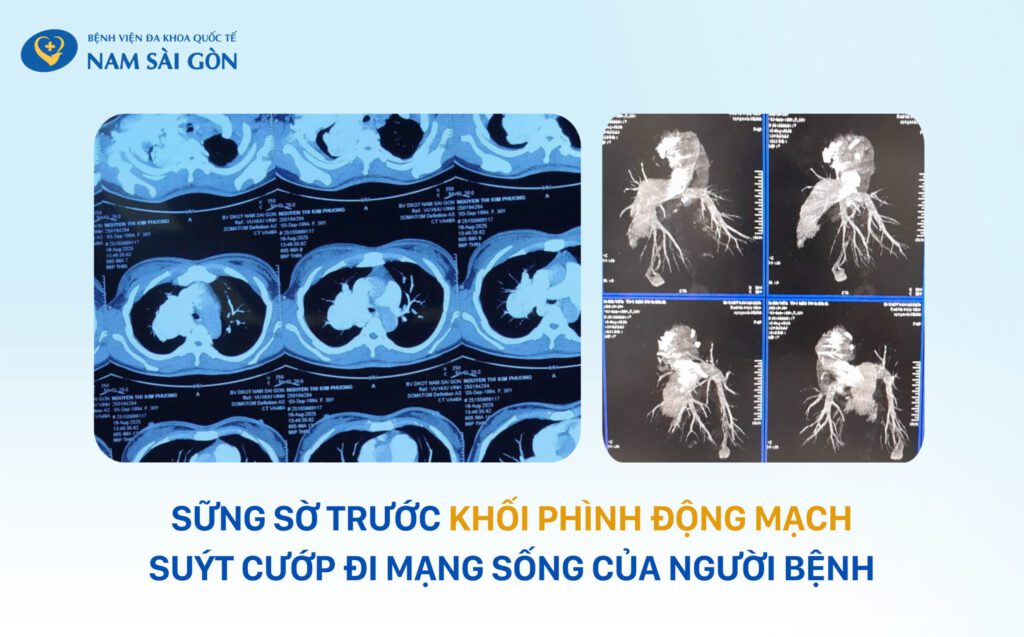 SỐC: NGƯỜI PHỤ NỮ 31 TUỔI MANG KHỐI PHÌNH ĐỘNG MẠCH PHỔI KHỔNG LỒ HIẾM GẶP 6 PHINH DONG MACH