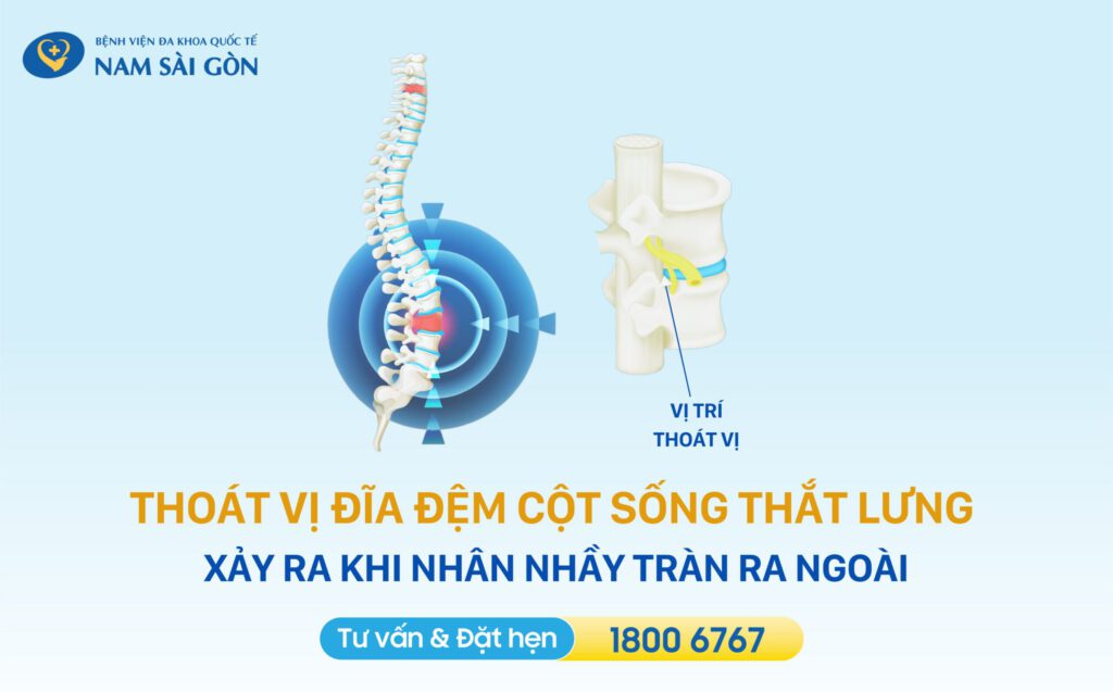 thoat-vi-dia-dem-cot-song-that-lung-la-gi