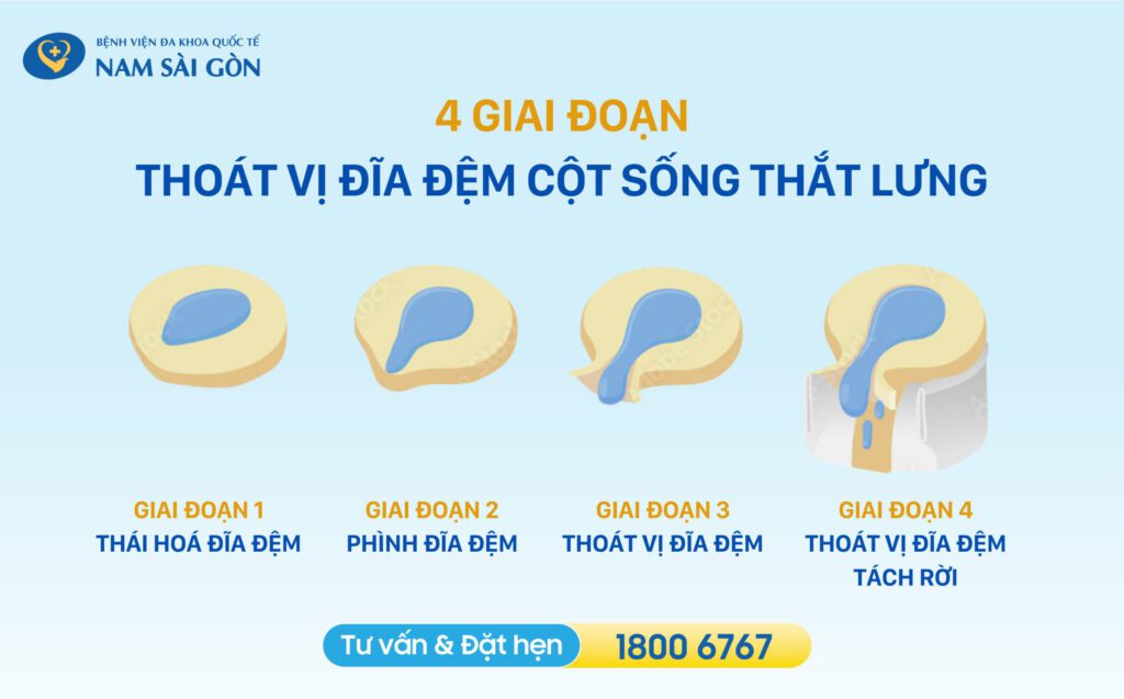 cac-gia-doan-thoat-vi-dia-dem-that-lung