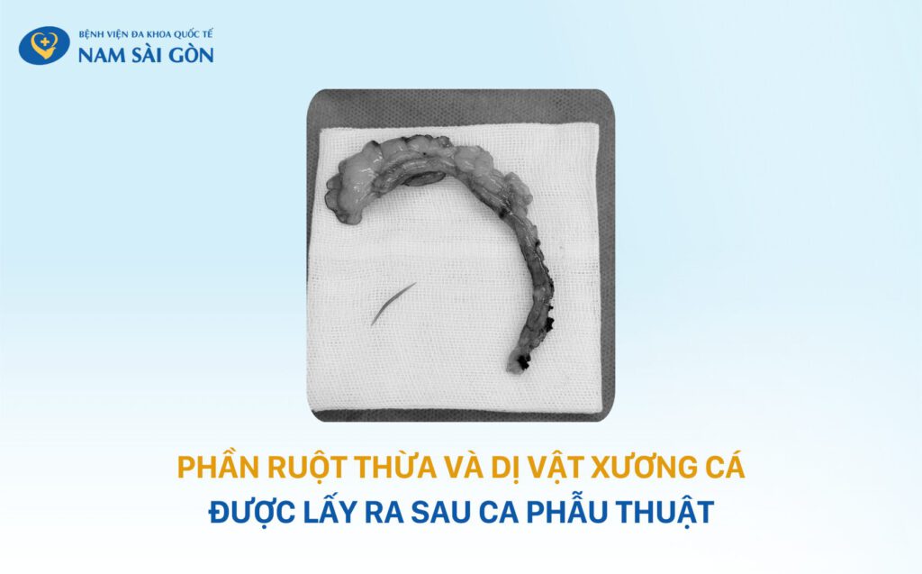 MẢNH XƯƠNG CÁ “ẨN MÌNH” SUÝT LẤY MẠNG CỤ ÔNG 64 TUỔI 4 Xuong ca H1 1