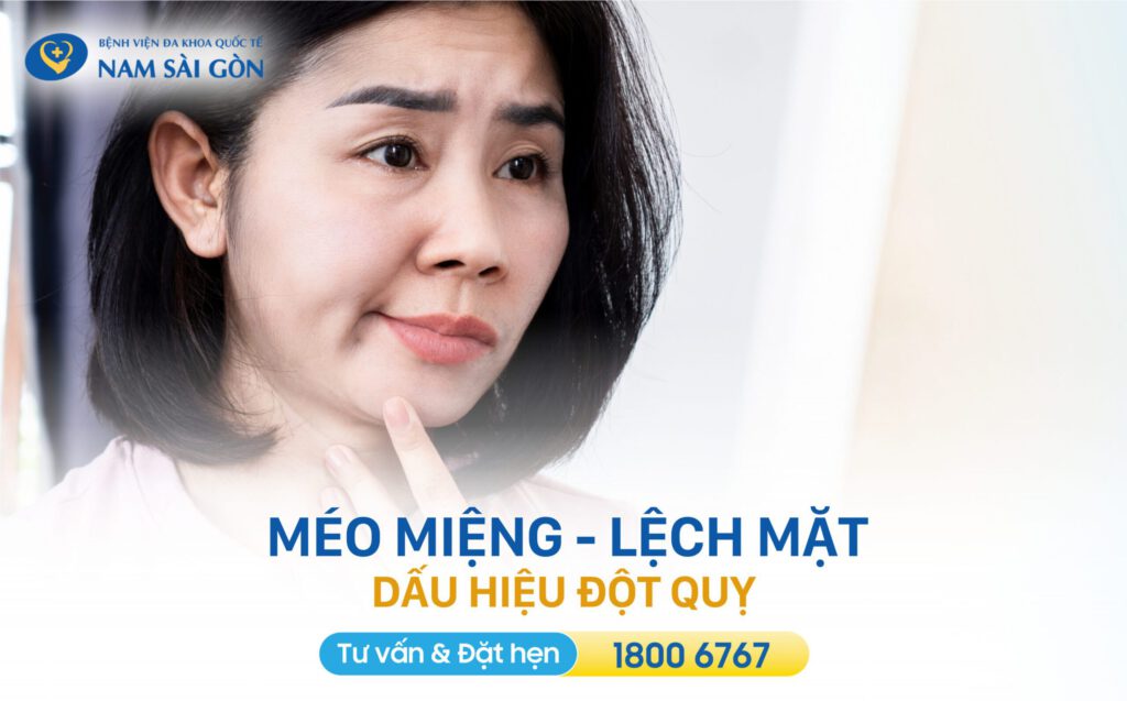 méo miệng là dấu hiệu điển hình của đột quỵ