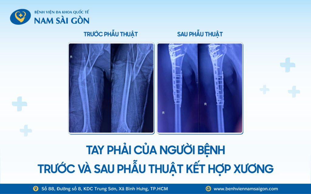 Web H2 Ca benh SUYT MAT CANH TAY SAU TAI NAN NAM THANH NIEN 26 TUOI HOI PHUC NGOAN MUC