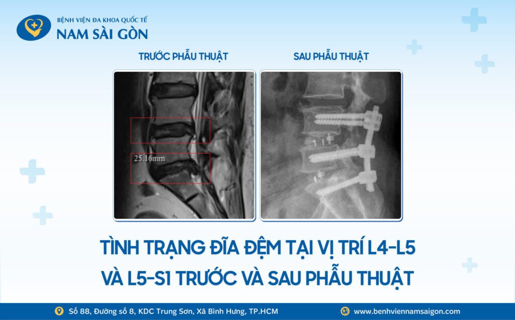 TỪ MẤT KHẢ NĂNG VẬN ĐỘNG VÌ THOÁT VỊ ĐĨA ĐỆM – ĐẾN ĐI LẠI BÌNH THƯỜNG SAU PHẪU THUẬT TLIF 7 Web H3 THOAT VI DIA DEM NHIEU TANG KHONG CON LA NOI LO NHO KY THUAT TLIF 1