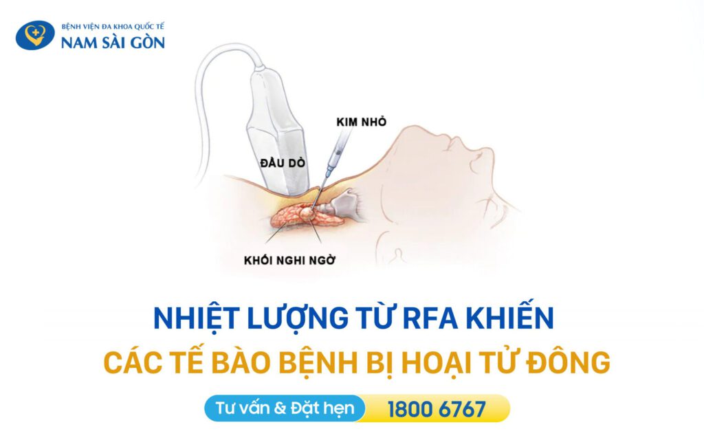 ĐỐT SÓNG CAO TẦN (RFA): KỸ THUẬT ĐIỀU TRỊ U LÀNH KHÔNG ĐAU, THẨM MỸ 12 DOT SONG CAO TAN RFA 2