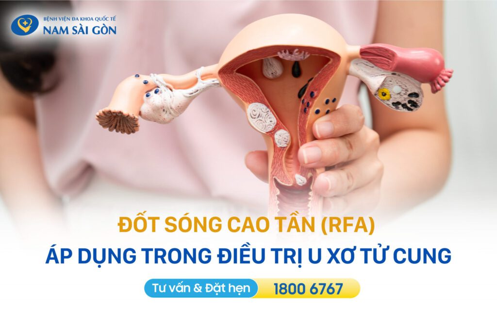 ĐỐT SÓNG CAO TẦN (RFA): KỸ THUẬT ĐIỀU TRỊ U LÀNH KHÔNG ĐAU, THẨM MỸ 14 DOT SONG CAO TAN RFA 4