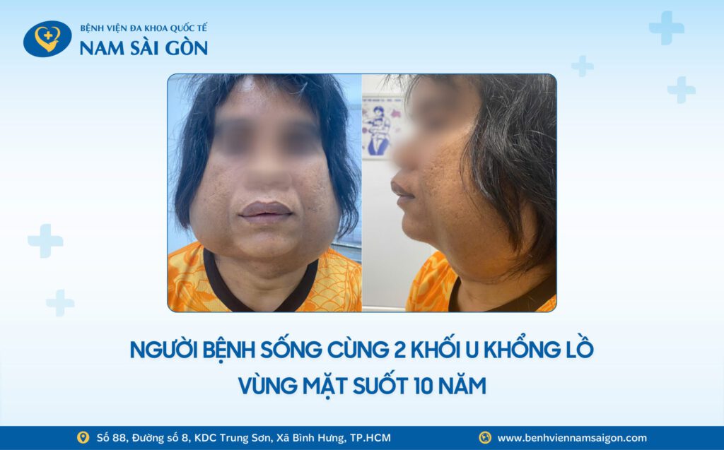 CHOÁNG: NAM THANH NIÊN SỐNG CÙNG 2 KHỐI U KHỔNG LỒ TRÊN MẶT SUỐT 10 NĂM 6 Web H2 Ca benh NAM THANH NIEN SONG CUNG 2 KHOI U KHONG LO TREN MAT SUOT 10 NAM 1