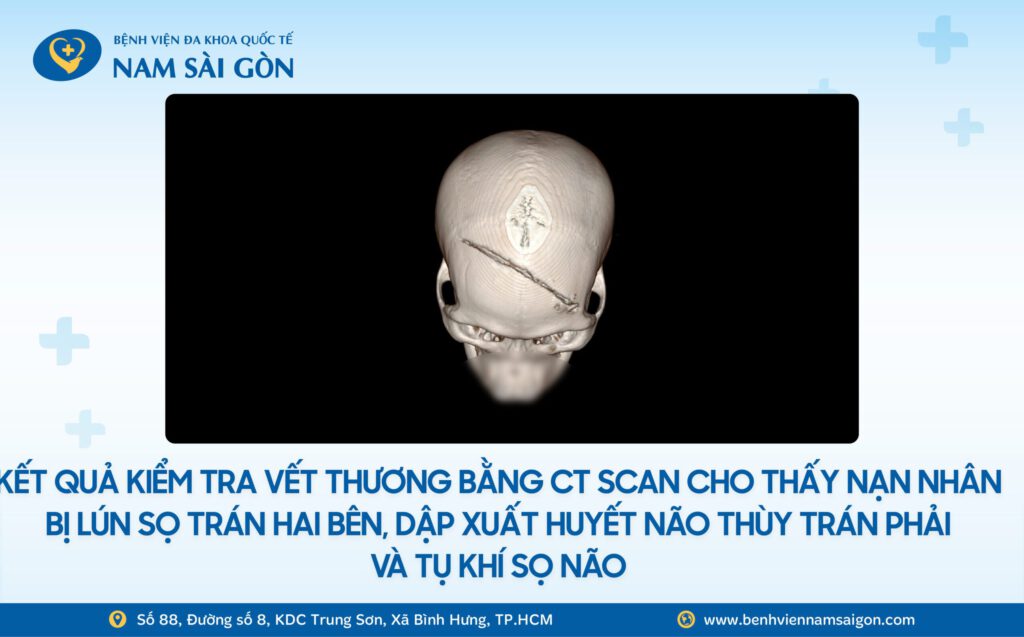 VỠ SỌ, DẬP NÃO SAU XÔ XÁT, NAM THANH NIÊN ĐƯỢC CỨU SỐNG ĐẦY NGOẠN MỤC TẠI BỆNH VIỆN NAM SÀI GÒN 5 Web H2 Ca benh VO SO DAP NAO SAU XO XAT