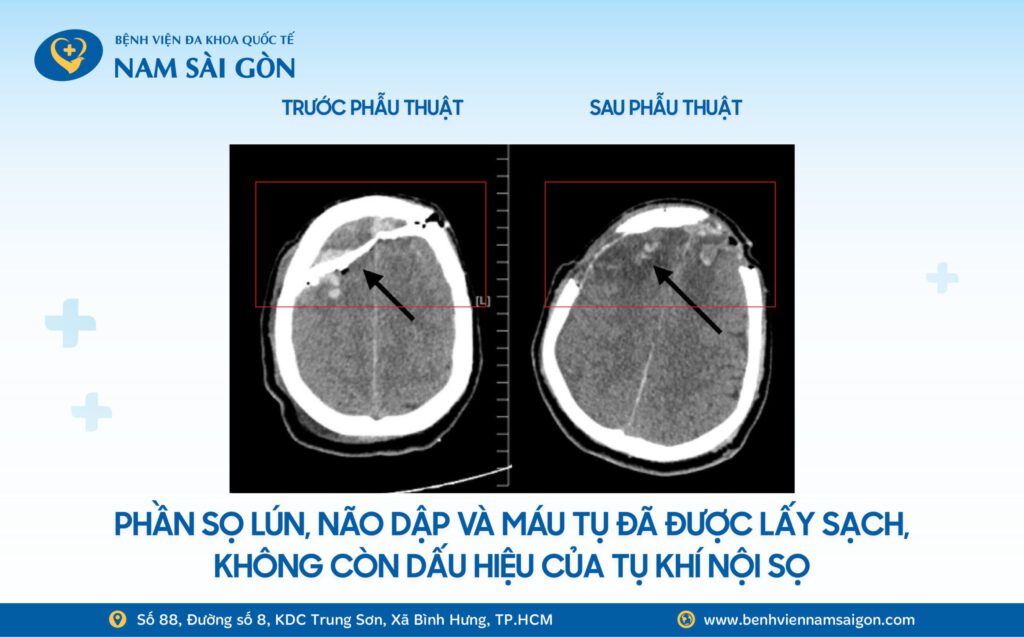 VỠ SỌ, DẬP NÃO SAU XÔ XÁT, NAM THANH NIÊN ĐƯỢC CỨU SỐNG ĐẦY NGOẠN MỤC TẠI BỆNH VIỆN NAM SÀI GÒN 6 Web H3 Ca benh VO SO DAP NAO SAU XO XAT