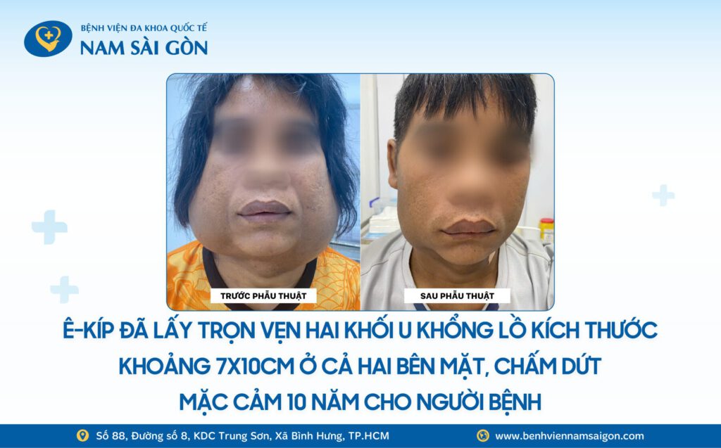 CHOÁNG: NAM THANH NIÊN SỐNG CÙNG 2 KHỐI U KHỔNG LỒ TRÊN MẶT SUỐT 10 NĂM 8 Web H4 Ca benh NAM THANH NIEN SONG CUNG 2 KHOI U KHONG LO TREN MAT SUOT 10 NAM