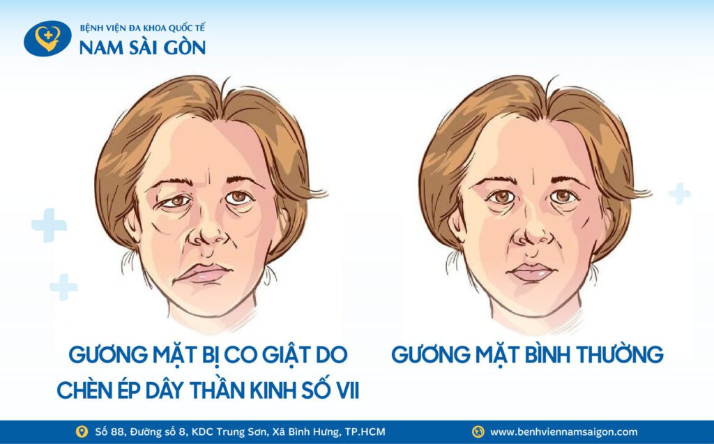 HÀNH TRÌNH TÌM LẠI NỤ CƯỜI SAU HƠN 1 NĂM BỊ CO GIẬT NỬA MẶT 6 Web H4 Ca benh NAM THANH NIEN SONG CUNG 2 KHOI U KHONG LO TREN MAT SUOT 10 NAM copy 2