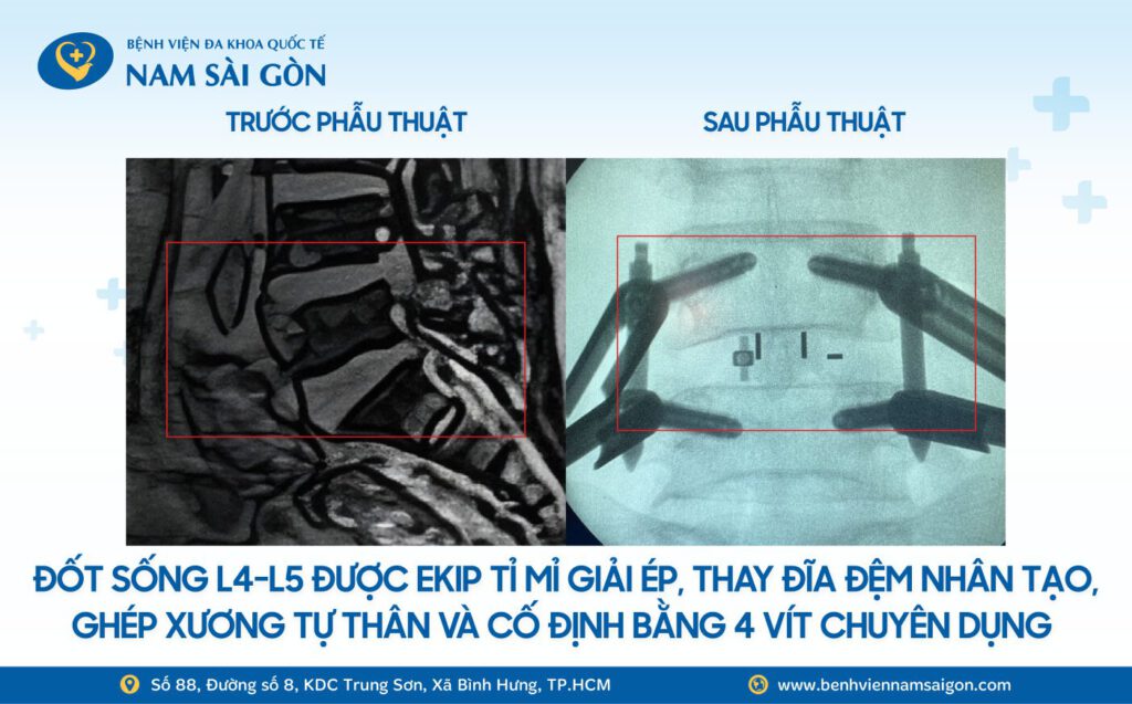 2025 11 07 Website H4 Ca benh MO COT SONG CUU NGUOI PHU NU CAO TUOI NHIEU BENH NEN KHOI NGUY CO LIE