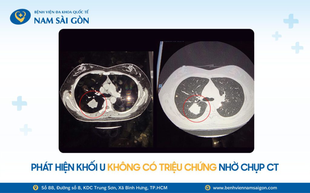 2025 11 12 Website H2 Ca benh TINH CO PHAT HIEN UNG THU PHOI NHO KHAM SUC KHOE DINH KY