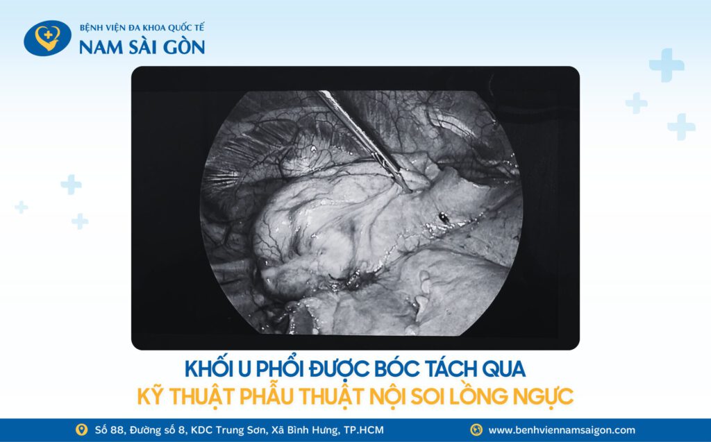 2025 11 12 Website H3 Ca benh TINH CO PHAT HIEN UNG THU PHOI NHO KHAM SUC KHOE DINH KY