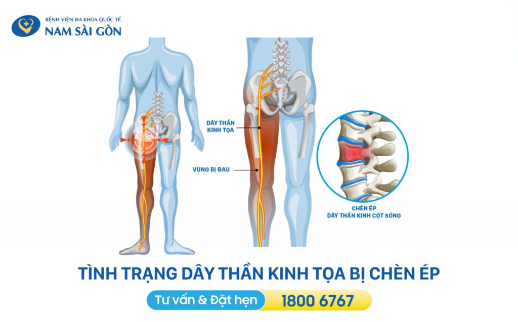tình trạng đau thần kinh tọa