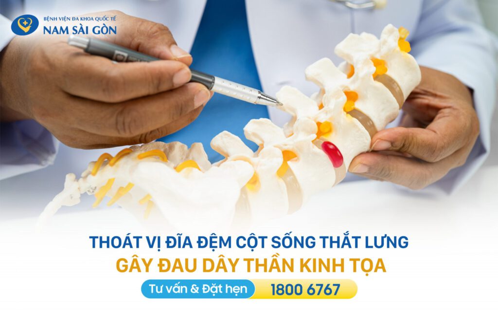 thoát vị đĩa đệm gây đau thần kinh tọa