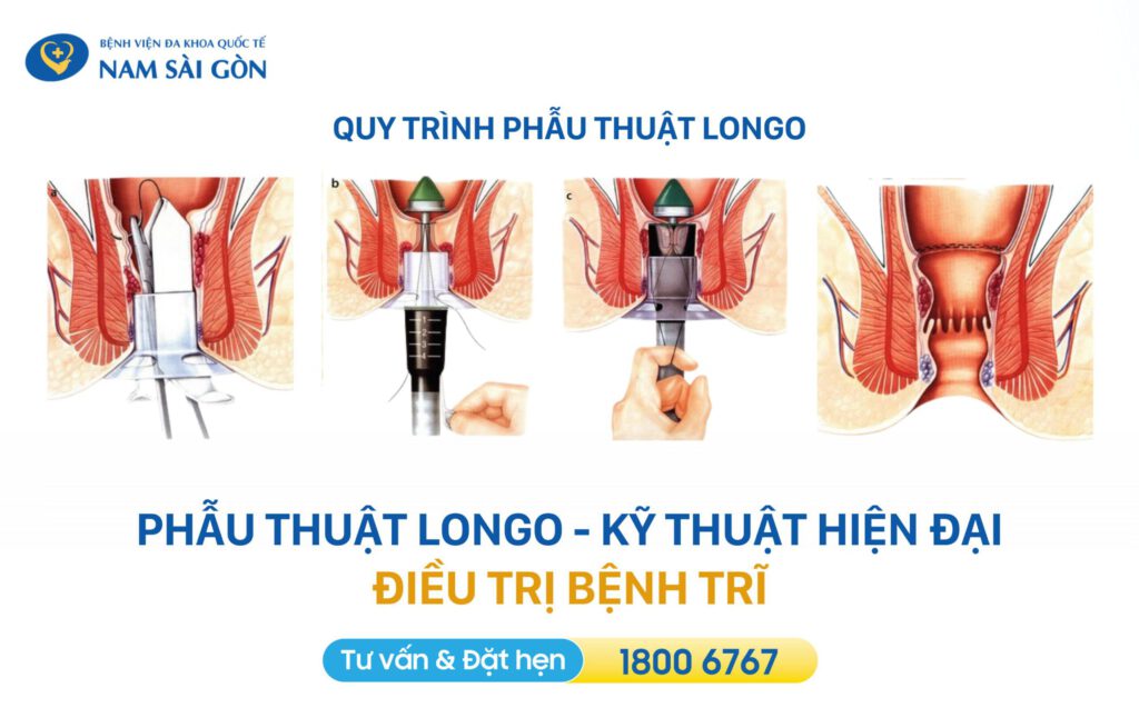 cách điều trị bệnh trĩ bằng phẫu thuật