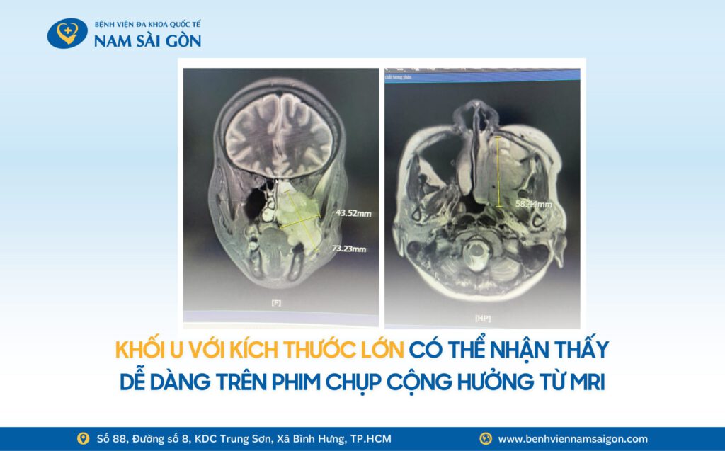 2026 01 08 Ca benh Website H2 DAU HAM NGHET MUI CHAY MAU RANG DI KHAM PHAT HIEN UNG THU XOANG