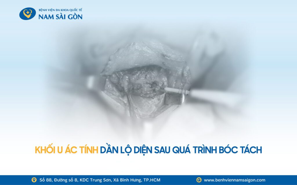 2026 01 08 Ca benh Website H4 DAU HAM NGHET MUI CHAY MAU RANG DI KHAM PHAT HIEN UNG THU XOANG