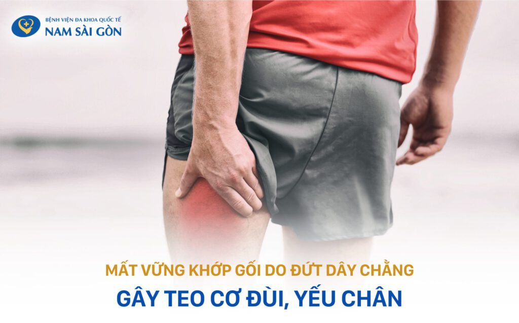 teo cơ là biến chứng đứt dây chằng chéo trước