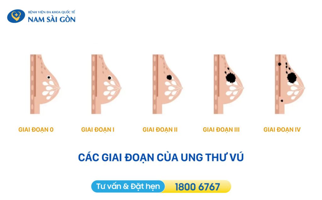 UNG THƯ VÚ GIAI ĐOẠN ĐẦU - CÁC GIAI ĐOẠN, BIỂU HIỆN VÀ ĐIỀU TRỊ 3 ung thư vú giai đoạn sớm gồm 5 giai đoạn