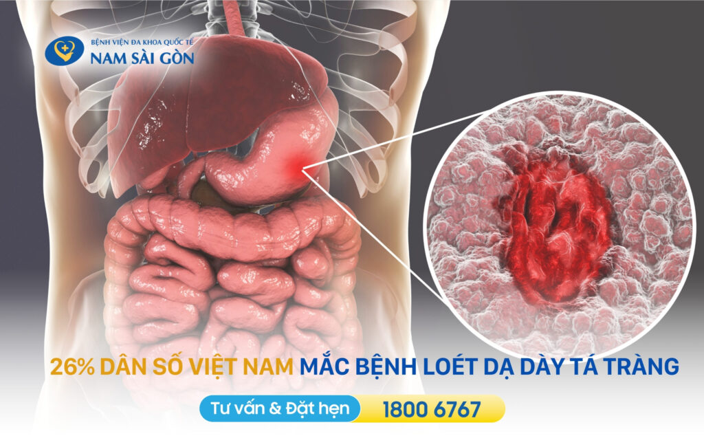 nguyên nhân đau dạ dày