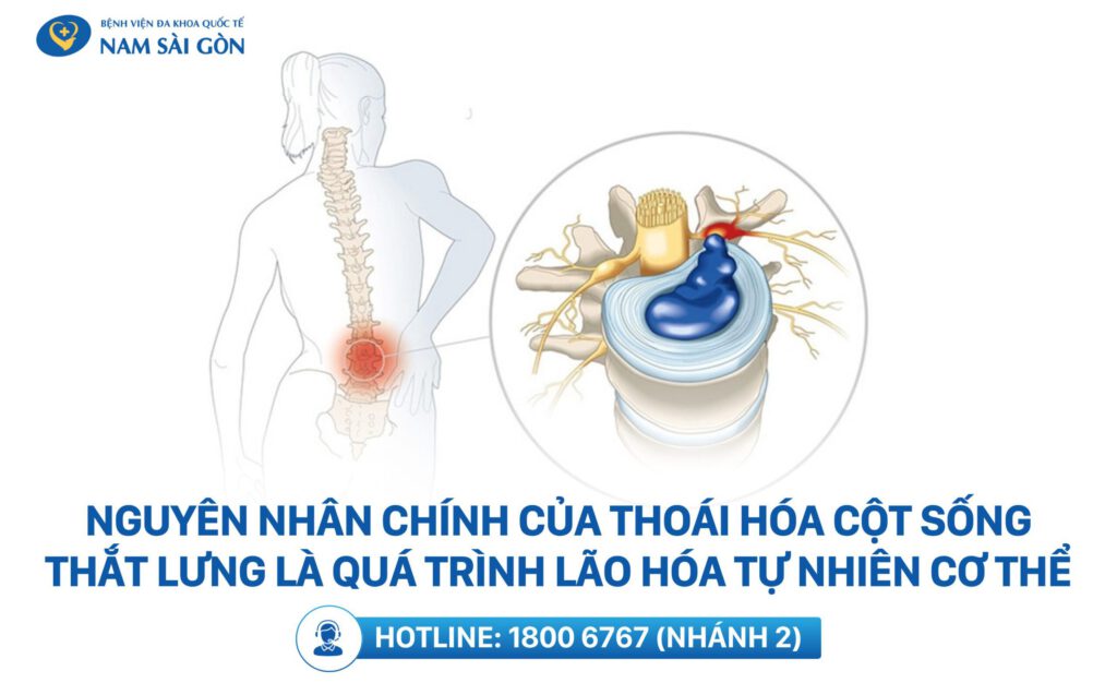 Nguyên nhân gây ra thoái hóa cột sống thắt lưng