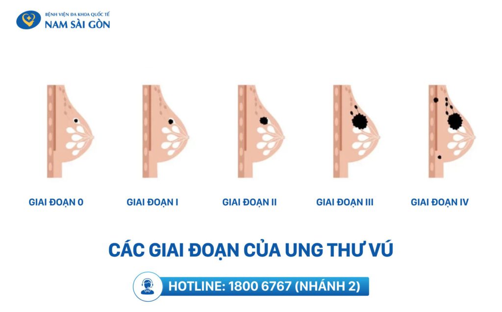 ung thư vú giai đoạn sớm gồm 5 giai đoạn